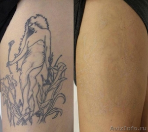 Перманентный макияж, татуаж. Лазерное удаление тату - Изображение #3, Объявление #1627864